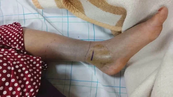 وفاة مواطنة بدوار إكضي بجماعة تزونين: أزمة نقل طبي وتوفر الأمصال تثير تساؤلات